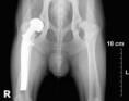 /album/fotogaleria-imagenologia/radiografia-de-cadera-jpg/